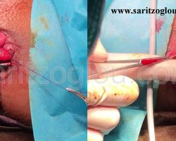 Εικόνα 3. Αιμορροϊδεκτομή με ψαλίδι υπερήχων.
Η εκτομή της αιμορροΐδας δεν προκαλεί καμία βλάβη στους σφικτήρες του πρωκτού