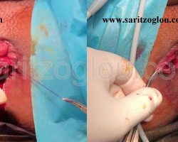 Εικόνα 4. Αιμορροϊδεκτομή με ψαλίδι υπερήχων.
Πλήρη αφαίρεση όλου του αιμορροϊδικού όζου αναίμακτα και με απόλυτη διαφύλαξη των γύρω ιστών εξασφαλίζει την ανώδυνη μετεγχειρητική πορεία.